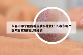 長(zhǎng)春市哪個(gè)醫(yī)院看皮膚科比較好 長(zhǎng)春市哪個(gè)醫(yī)院看皮膚科比較好的