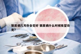 銀屑病幾月份會見好 銀屑病什么時候有望攻克?