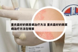 重慶最好的銀屑病治療方法 重慶最好的銀屑病治療方法在哪里