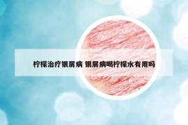 檸檬治療銀屑病 銀屑病喝檸檬水有用嗎