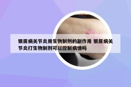 銀屑病關(guān)節(jié)炎用生物制劑的副作用 銀屑病關(guān)節(jié)炎打生物制劑可以控制病情嗎