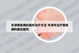 天津銀屑病的最好治療方法 天津市治療銀屑病的最佳醫(yī)院