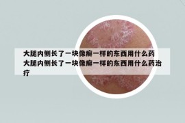 大腿內(nèi)側(cè)長(zhǎng)了一塊像癬一樣的東西用什么藥 大腿內(nèi)側(cè)長(zhǎng)了一塊像癬一樣的東西用什么藥治療
