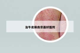 治牛皮癬南京最好醫(yī)院