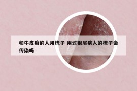和牛皮癬的人用梳子 用過(guò)銀屑病人的梳子會(huì)傳染嗎
