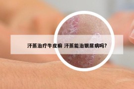 汗蒸治療牛皮癬 汗蒸能治銀屑病嗎?