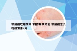 銀屑病吃維生素c的作用及功能 銀屑病怎么吃維生素c片