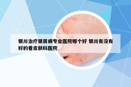 銀川治療銀屑病專(zhuān)業(yè)醫(yī)院哪個(gè)好 銀川有沒(méi)有好的看皮膚科醫(yī)院