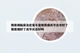 銀屑病臨床治愈是不是銀屑病關(guān)節(jié)炎也好了 銀屑病好了關(guān)節(jié)炎會(huì)好嗎