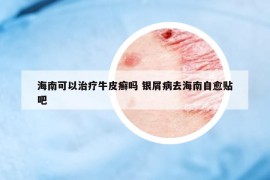 海南可以治療牛皮癬嗎 銀屑病去海南自愈貼吧