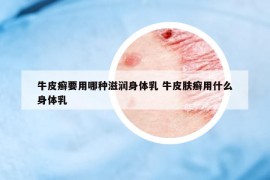 牛皮癬要用哪種滋潤身體乳 牛皮膚癬用什么身體乳