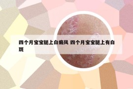 四個月寶寶腿上白癜風 四個月寶寶腿上有白斑