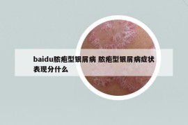 baidu膿皰型銀屑病 膿皰型銀屑病癥狀表現(xiàn)分什么