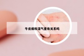 牛皮癬和濕氣重有關(guān)系嗎