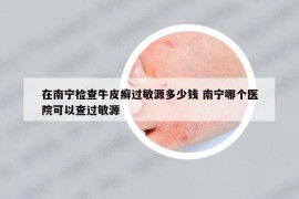 在南寧檢查牛皮癬過敏源多少錢 南寧哪個(gè)醫(yī)院可以查過敏源