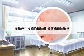 有治療牛皮癬的精油嗎 銀屑病精油治療