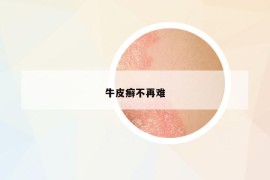 牛皮癬不再難