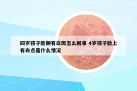 四歲孩子臉頰有白斑怎么回事 4歲孩子臉上有白點(diǎn)是什么情況