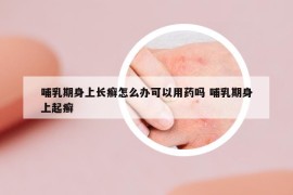 哺乳期身上長(zhǎng)癬怎么辦可以用藥嗎 哺乳期身上起癬