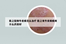 臉上輕微牛皮癬怎么治療 臉上有牛皮癬癬用什么藥膏好
