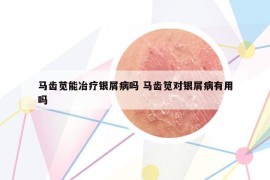 馬齒莧能冶療銀屑病嗎 馬齒筧對(duì)銀屑病有用嗎