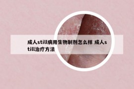 成人still病用生物制劑怎么樣 成人still治療方法