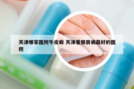天津哪家醫(yī)院牛皮癬 天津看銀屑病最好的醫(yī)院
