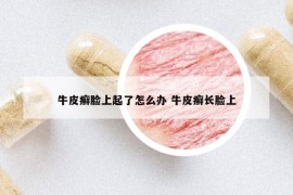 牛皮癬臉上起了怎么辦 牛皮癬長(zhǎng)臉上