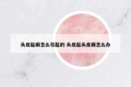 頭皮起癬怎么引起的 頭皮起頭皮癬怎么辦