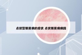 點(diǎn)狀型銀屑病的癥狀 點(diǎn)狀銀屑病病因