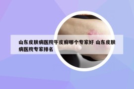 山東皮膚病醫(yī)院牛皮癬哪個專家好 山東皮膚病醫(yī)院專家排名