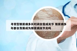 尋常型銀屑病多長時間會變成關(guān)節(jié) 銀屑病多年都會發(fā)展成為銀屑病關(guān)節(jié)炎嗎