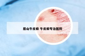 眉山牛皮癬 牛皮癬專治醫(yī)院