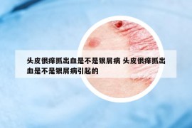 頭皮很癢抓出血是不是銀屑病 頭皮很癢抓出血是不是銀屑病引起的