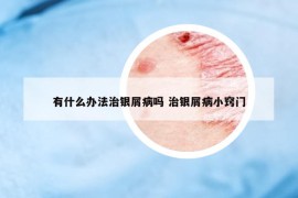 有什么辦法治銀屑病嗎 治銀屑病小竅門