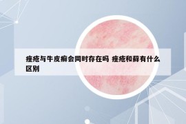 痤瘡與牛皮癬會(huì)同時(shí)存在嗎 痤瘡和蘚有什么區(qū)別