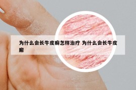 為什么會(huì)長(zhǎng)牛皮癬怎樣治疔 為什么會(huì)長(zhǎng)牛皮廨