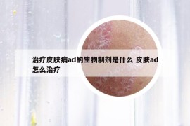 治療皮膚病ad的生物制劑是什么 皮膚ad怎么治療