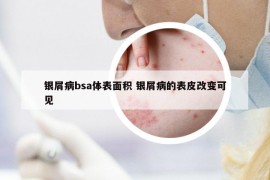 銀屑病bsa體表面積 銀屑病的表皮改變可見