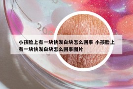 小孩臉上有一塊快發(fā)白塊怎么回事 小孩臉上有一塊快發(fā)白塊怎么回事圖片