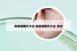 膿皰病圖片大全 膿皰病圖片大全 癥狀