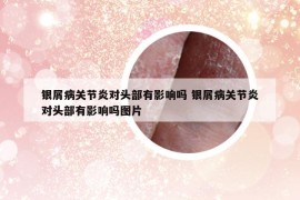銀屑病關(guān)節(jié)炎對(duì)頭部有影響嗎 銀屑病關(guān)節(jié)炎對(duì)頭部有影響嗎圖片
