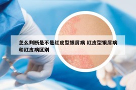 怎么判斷是不是紅皮型銀屑病 紅皮型銀屑病和紅皮病區(qū)別