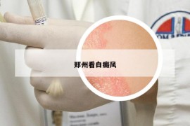 鄭州看白癜風(fēng)