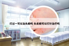 打過(guò)一可以治頭癬嗎 頭皮癬可以打針治療嗎