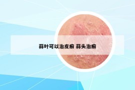 蒜葉可以治皮癬 蒜頭治癬