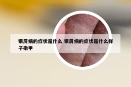 銀屑病的癥狀是什么 銀屑病的癥狀是什么樣子指甲