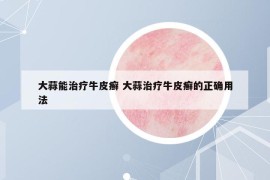 大蒜能治療牛皮癬 大蒜治療牛皮癬的正確用法