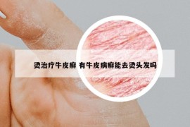 燙治療牛皮癬 有牛皮病癬能去燙頭發(fā)嗎
