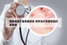 銀屑病是不是真菌感染 如何治療真菌感染的皮膚病